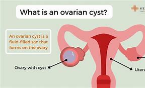 Image result for Ovary Cyst Size