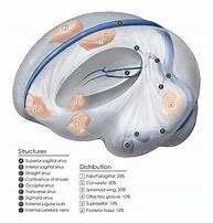 Image result for Olfactory Groove Meningioma