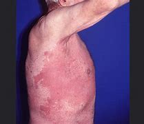 Image result for Disseminated Candidiasis