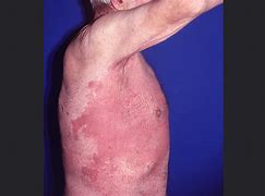 Image result for Disseminated Candidiasis Symptoms