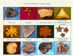 Image result for Four Types of Kidney Stones