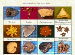 Image result for Kidney Stone Color