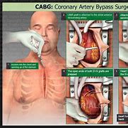 Image result for Open Heart Surgery Intraoperative