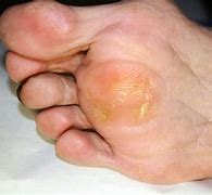 Image result for Calluses Soles
