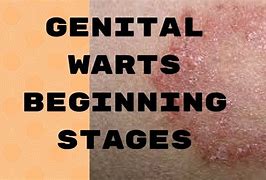 Image result for Genital Wart Locations