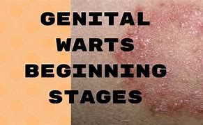 Image result for Early Genital Warts