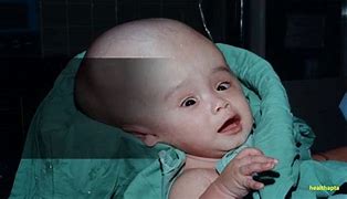 Image result for Hydrocephalus Down Syndrome