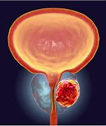 Image result for Prostate Cancer Tumor