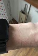 Image result for Mark On Wrist From Apple Watch