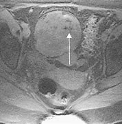 Image result for Teratoma Tumor Ovary