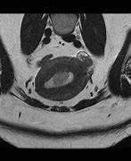 Image result for Endometrial Cancer Staging