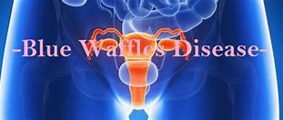Image result for Female Vulvar Diseases