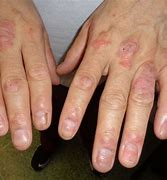 Image result for Skin Disorders Hands
