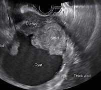 Image result for 6 Cm Cyst On Ovary