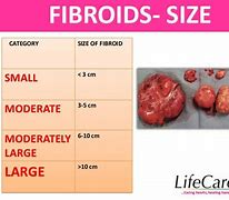 Image result for 6 Cm Fibroid