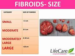 Image result for 8 Cm Fibroid