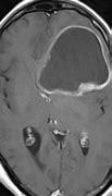 Image result for Glioblastoma Multiforme MRI