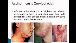 Image result for axtinomicosis