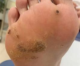 Image result for Wart On Foot Bottom