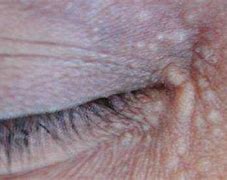 Image result for Filiform Warts On Eyelids