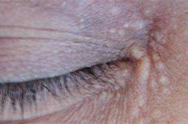 Image result for Warts around Eyes