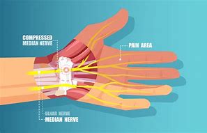 Image result for Wrist Ligament Tear