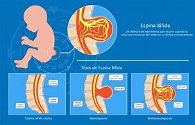 Image result for Spina Bifida S1