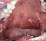 Image result for Strep Throat On Roof of Mouth