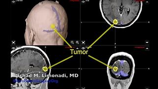 Image result for Occipital Lobe Tumor Symptoms