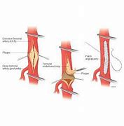 Image result for Femoral Artery Endarterectomy