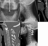 Image result for Anterior C2 Odontoid Screw Placement