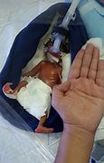 Image result for World's Smallest Baby in the UK