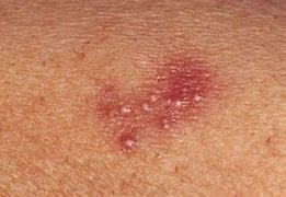 Image result for Chlamydia Symptoms Images