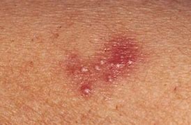 Image result for Chlamydia Infection On Skin