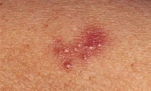 Image result for Chlamydia Skin Lesions