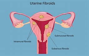 Image result for Size of Uterine Fibroids