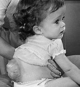 Image result for Infant with Spina Bifida
