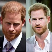 Image result for Prince Harry Before and After Hair Transplant