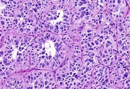 Image result for Carcinoid Tumor Histology