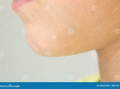 Image result for Molluscum Warts in Children