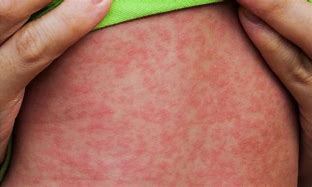 Image result for Fifth Disease Virus