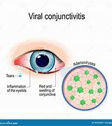Image result for Viral/Bacterial Conjunctivitis