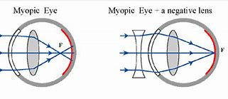 Image result for Myopia Light Rays