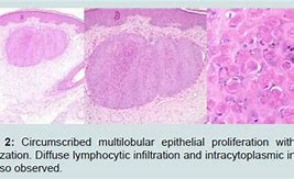 Image result for Molluscum Contagiosum Cure