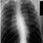 Image result for Uresil Pneumothorax Kit