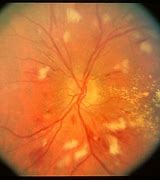 Image result for Leukemia Eyes