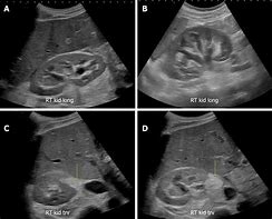 Image result for Normal Kidney MRI