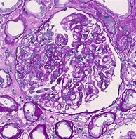 Image result for IgA Nephropathy Histology