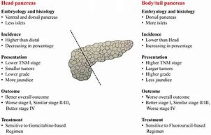 Image result for Tumor On Pancreas Tail