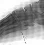 Image result for Jones Fracture Foot Treatment